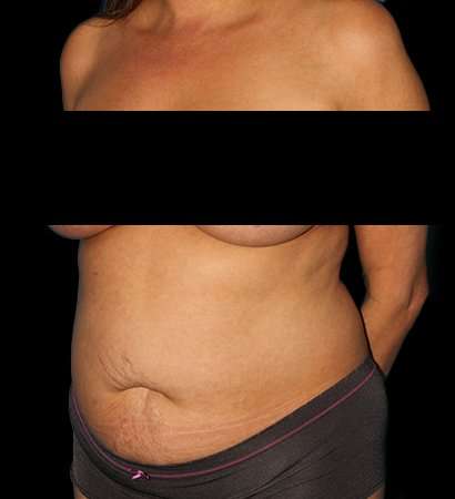 Tummy Tuck Before & After Patient #2201