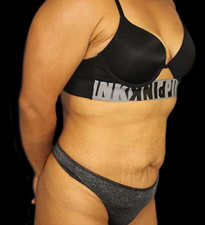 Tummy Tuck Before & After Patient #2212