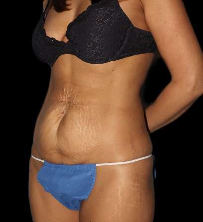 Tummy Tuck Before & After Patient #2269