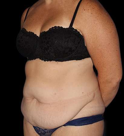 Tummy Tuck Before & After Patient #2280