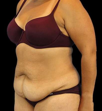 Tummy Tuck Before & After Patient #2291