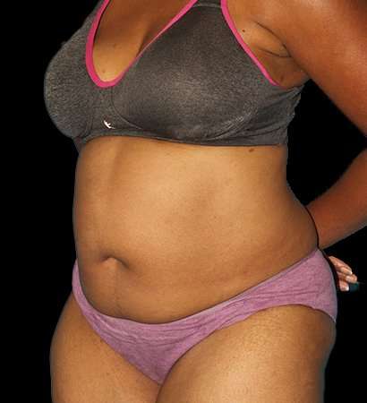 Tummy Tuck Before & After Patient #2302
