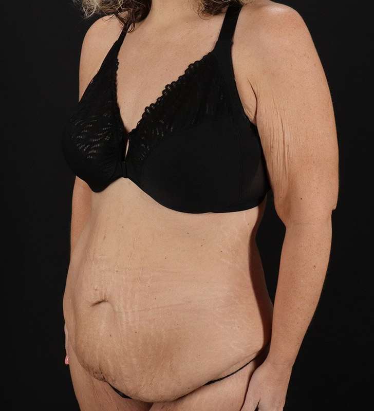 Tummy Tuck Before & After Patient #2326