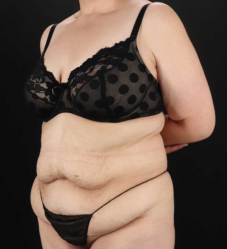 Tummy Tuck Before & After Patient #2339