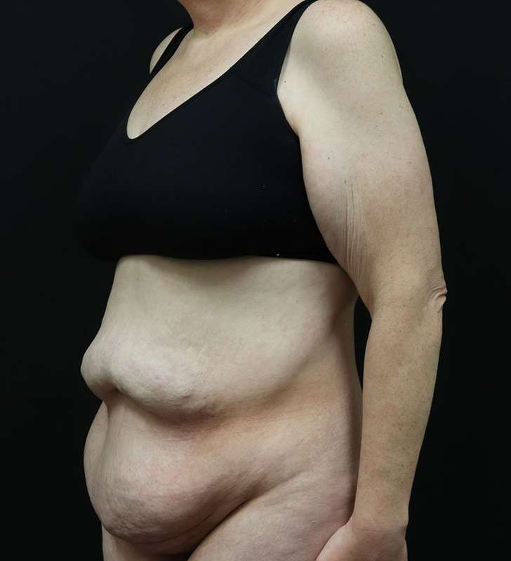 Tummy Tuck Before & After Patient #2363