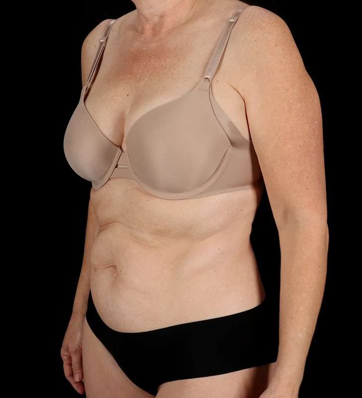 Tummy Tuck Before & After Patient #2435