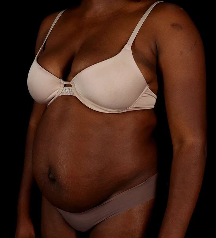 Tummy Tuck Before & After Patient #2448