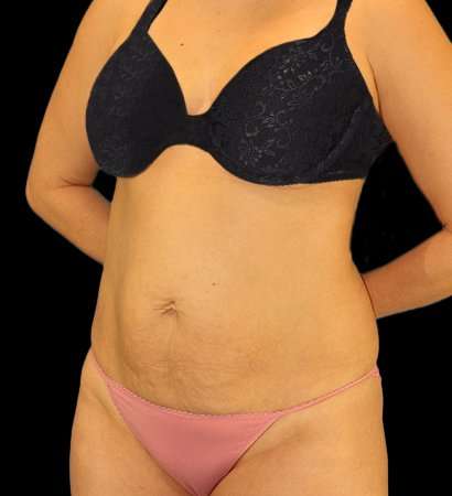 Tummy Tuck Before & After Patient #2485