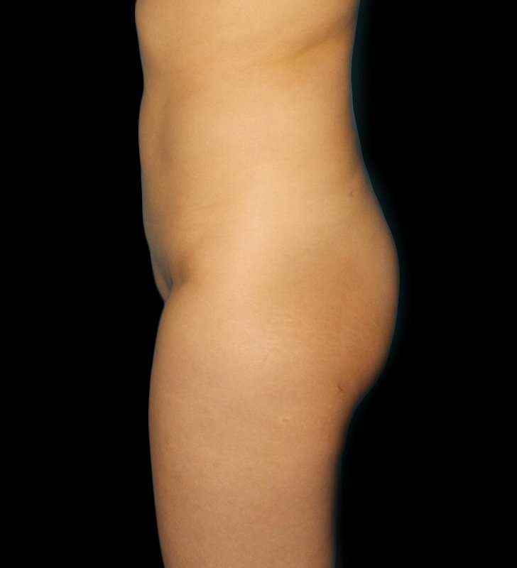 Brazilian Butt Lift Before & After Patient #2496