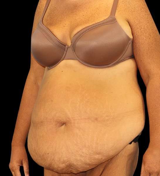 Circumferential Body Lift Before & After Patient #2509