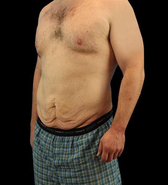Circumferential Body Lift Before & After Patient #2522