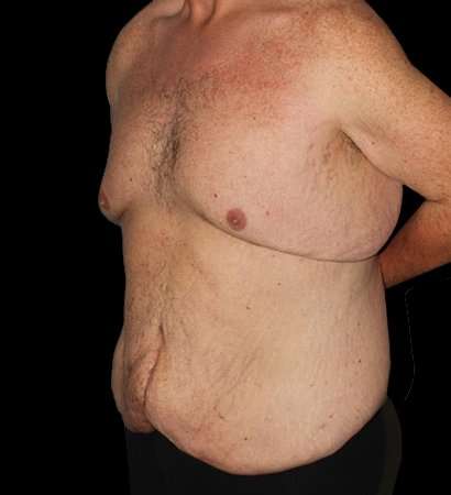 Massive Weight Loss Before & After Patient #5155