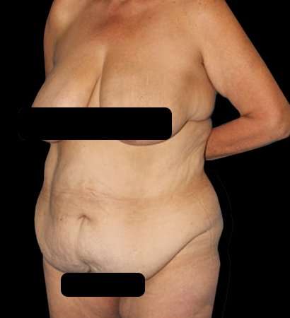 Circumferential Body Lift Before & After Patient #2572