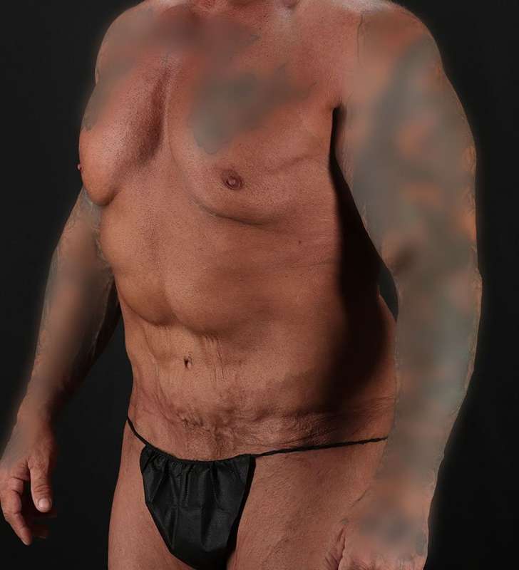 Circumferential Body Lift Before & After Patient #2611