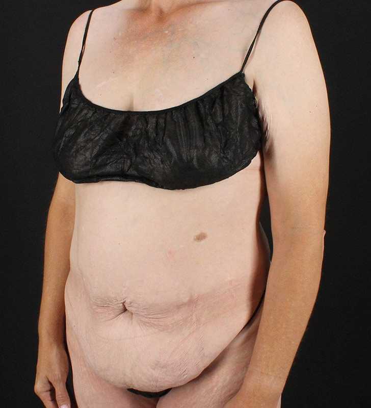 Circumferential Body Lift Before & After Patient #2624