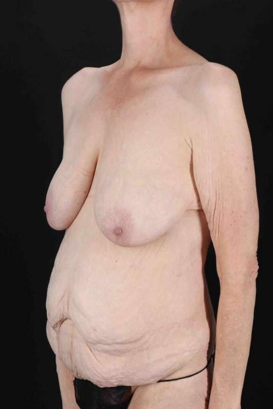 Circumferential Body Lift Before & After Patient #2663