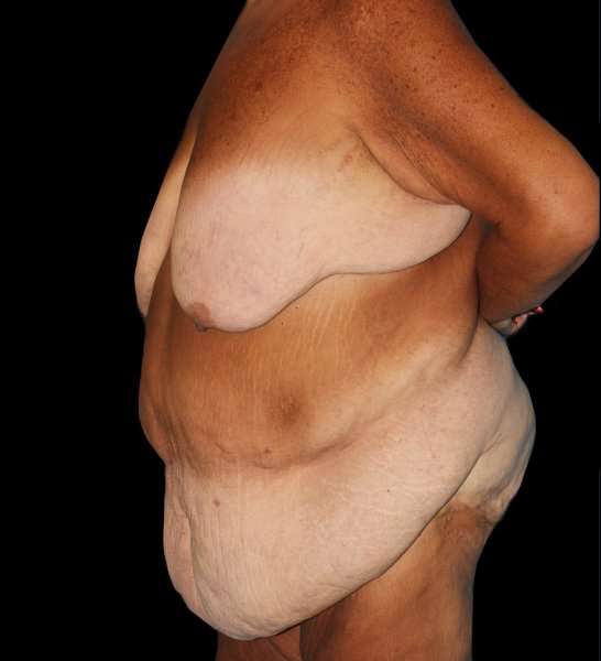 Fleur De Lis Circumferential Body Lift Before & After Patient #2674