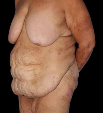 Fleur De Lis Circumferential Body Lift Before & After Patient #2685