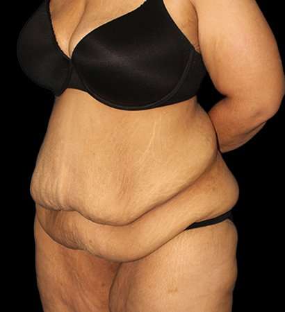 Fleur De Lis Tummy Tuck Before & After Patient #2703