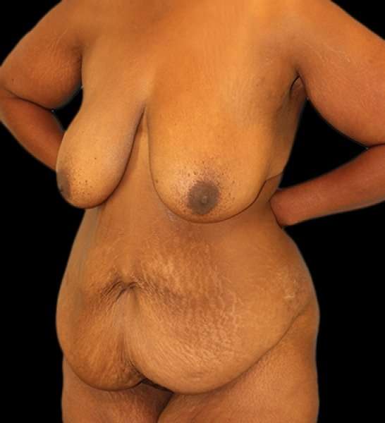 Fleur De Lis Tummy Tuck Before & After Patient #2714