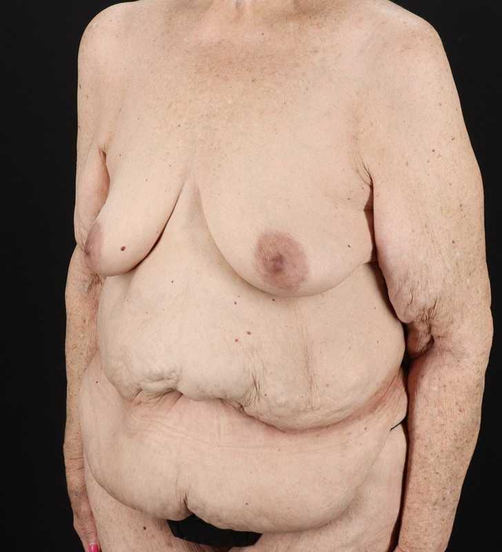 Fleur De Lis Tummy Tuck Before & After Patient #2727
