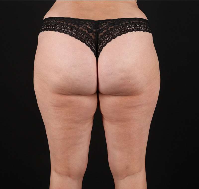 Liposuction Before & After Patient #2736