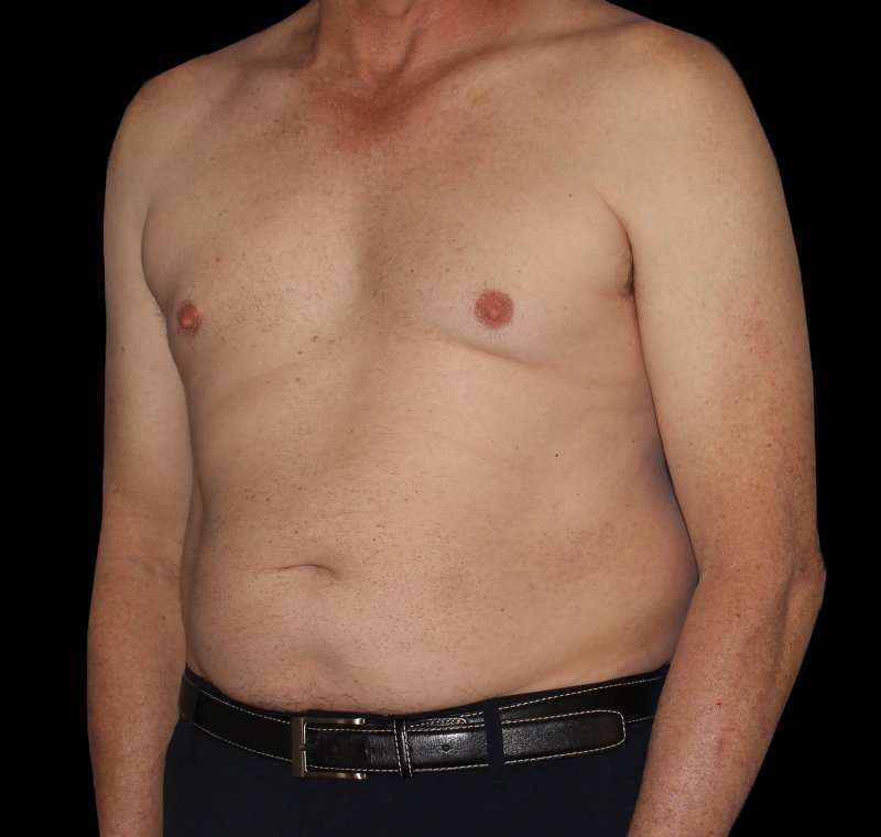 Liposuction Before & After Patient #2756