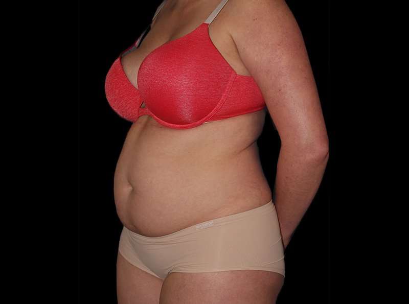 Liposuction Before & After Patient #2778