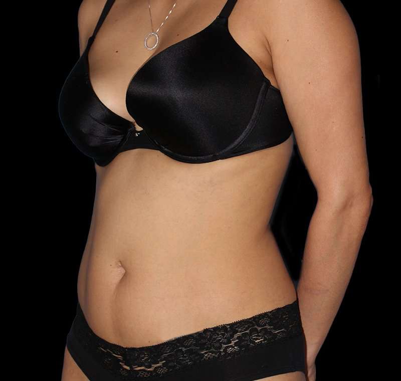 Liposuction Before & After Patient #2811