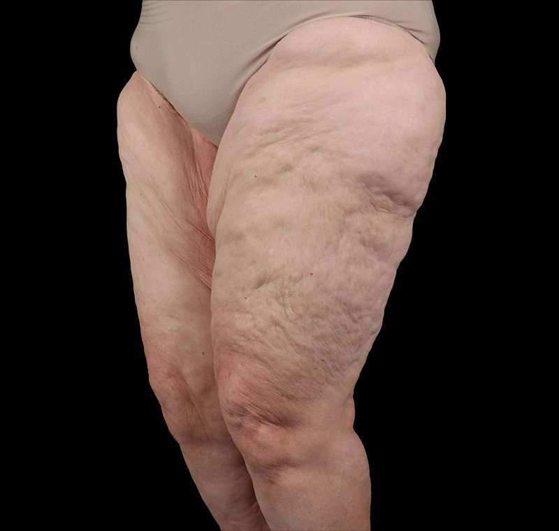 Liposuction Before & After Patient #2829