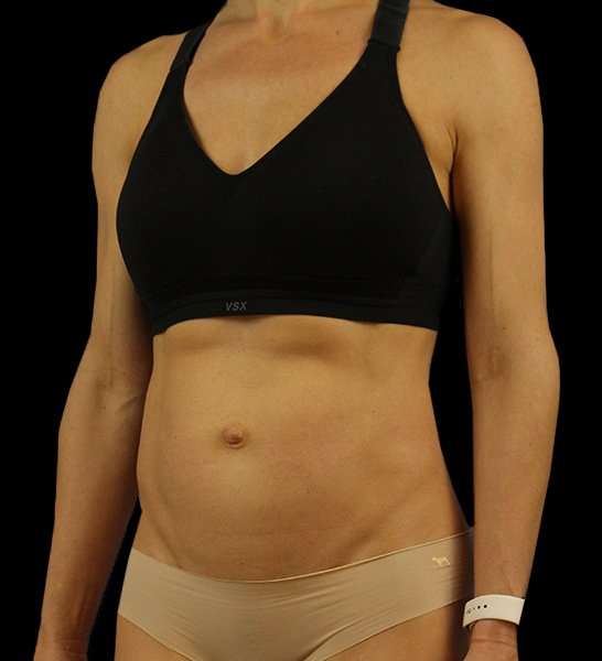 Mini Tummy Tuck Before & After Patient #2856