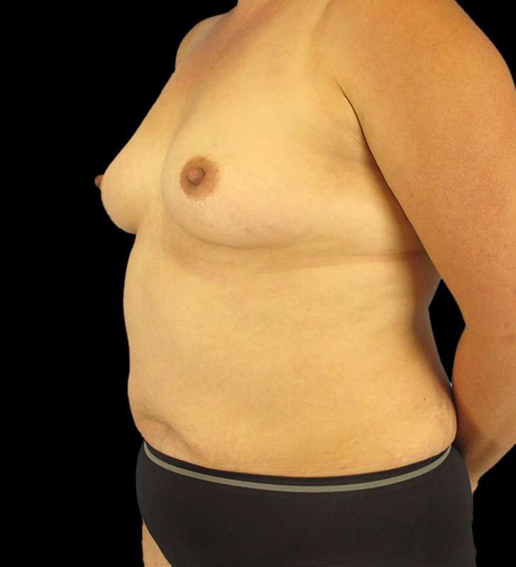 Mommy Makeover Before & After Patient #2878