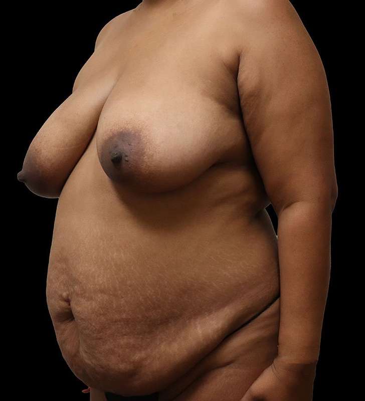 Mommy Makeover Before & After Patient #2926