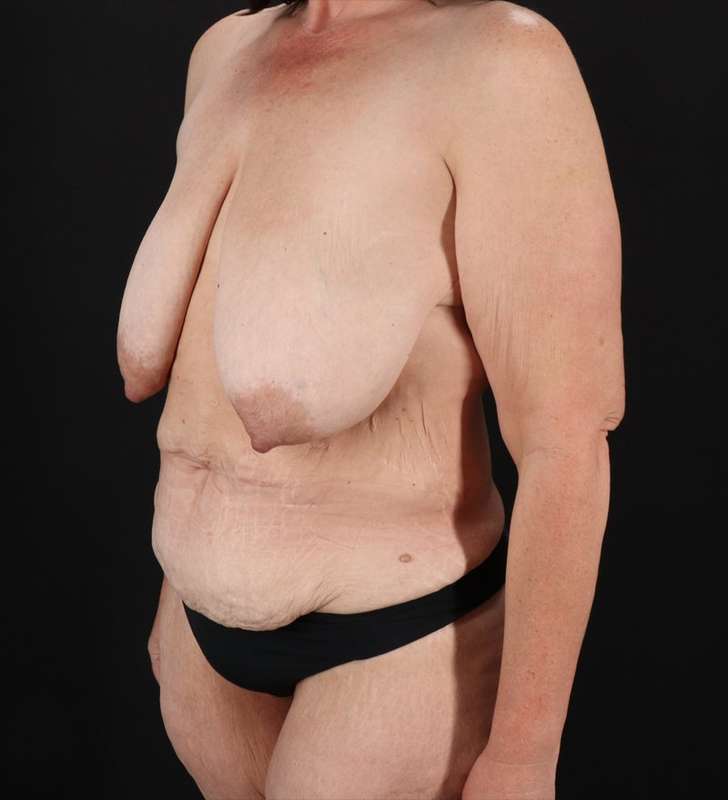 Mommy Makeover Before & After Patient #2950
