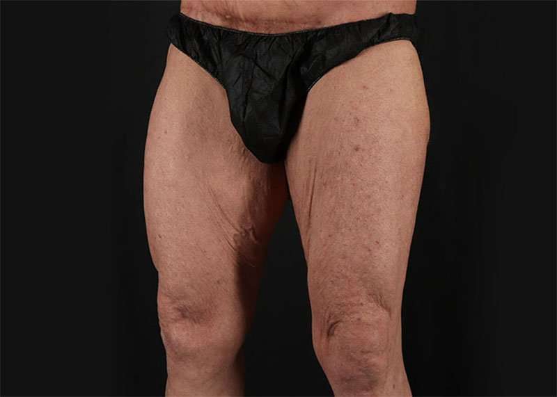 Thigh Lift Before & After Patient #2992