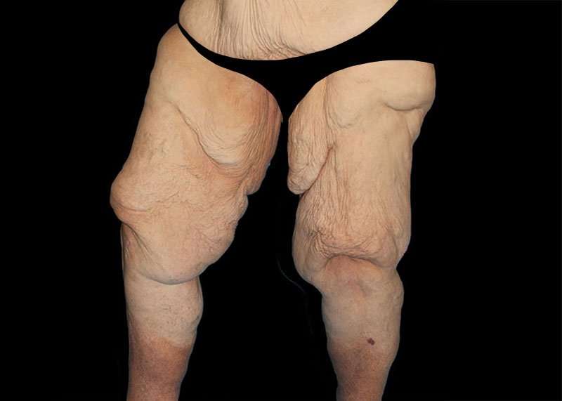 Thigh Lift Before & After Patient #3005