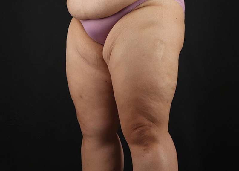 Thigh Lift Before & After Patient #3018