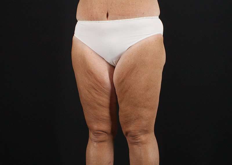 Thigh Lift Before & After Patient #3031