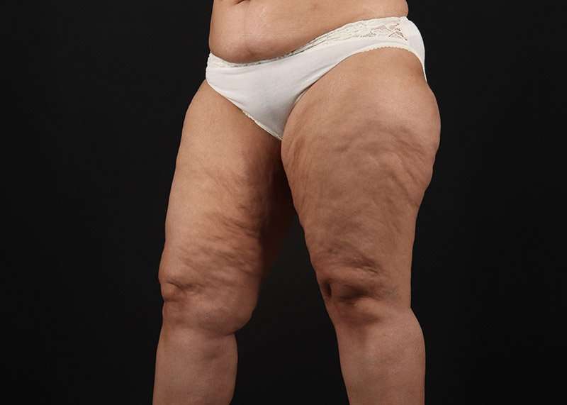 Thigh Lift Before & After Patient #3044