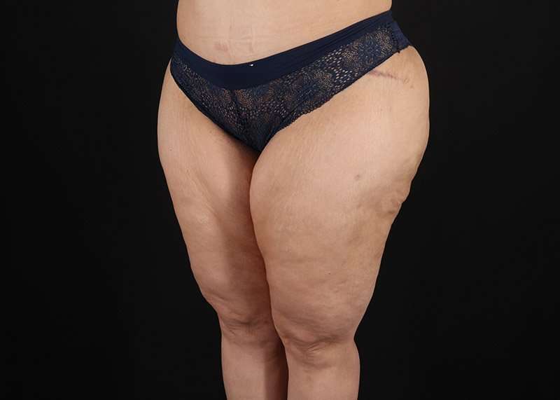 Thigh Lift Before & After Patient #3057