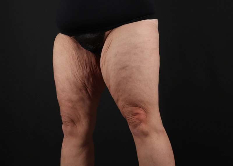 Thigh Lift Before & After Patient #3070