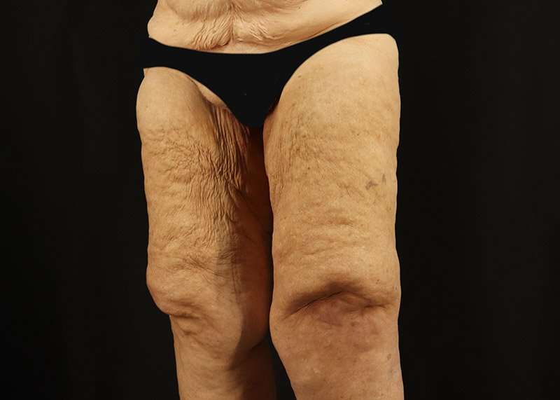 Thigh Lift Before & After Patient #3083