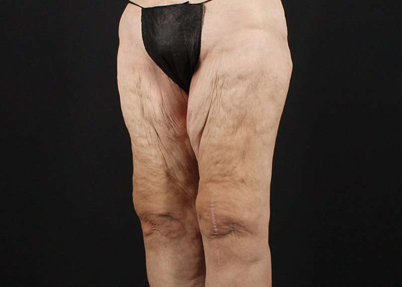 Thigh Lift Before & After Patient #3096