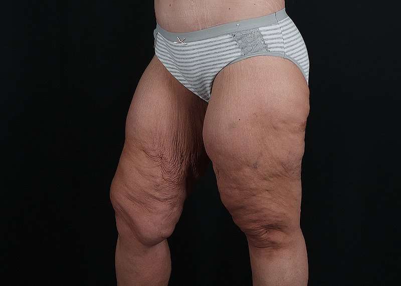 Thigh Lift Before & After Patient #3109