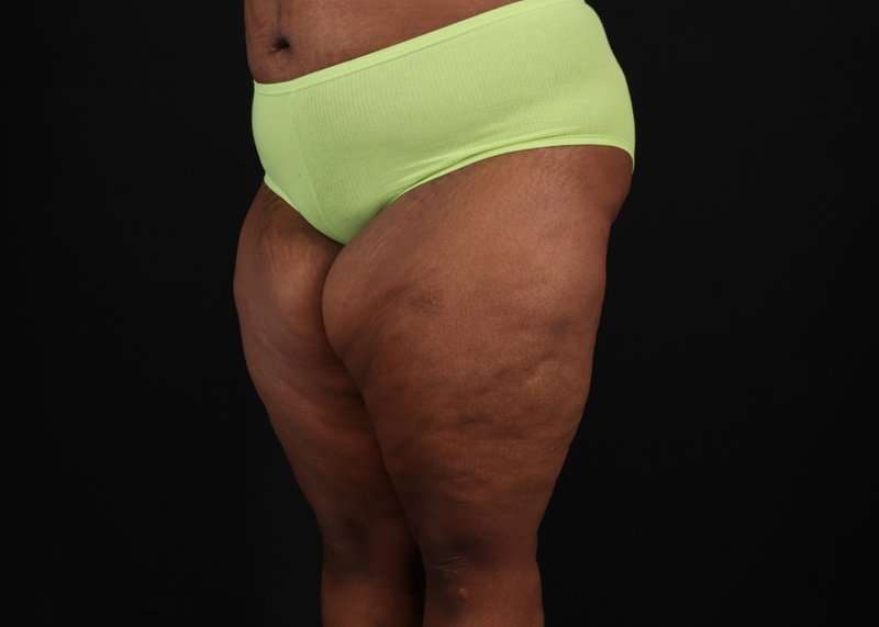 Thigh Lift Before & After Patient #3122