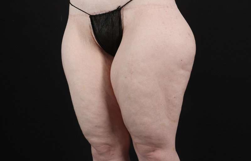 Thigh Lift Before & After Patient #3135