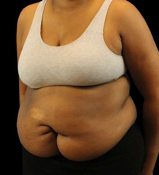 Tummy Tuck Revision Before & After Patient #3146