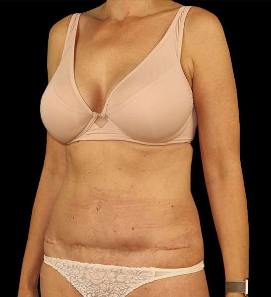 Tummy Tuck Revision Before & After Patient #3157