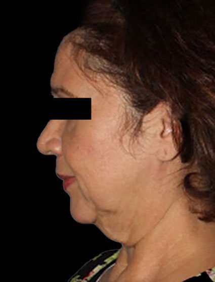 Face & Neck Lift Before & After Patient #3248