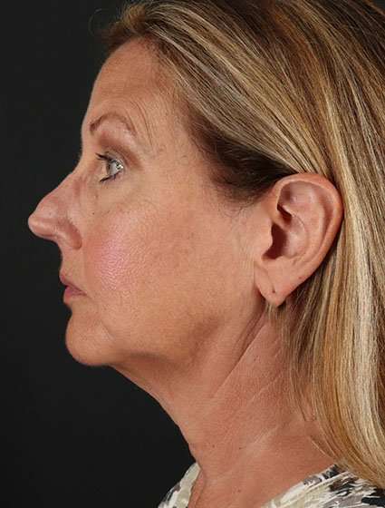 Face & Neck Lift Before & After Patient #3259